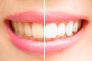 before and after teeth whitening