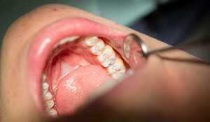 Dentist examines metal free crown adjustments