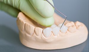 Model of three tooth dental bridge
