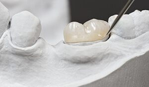 Dental model showing a large filling