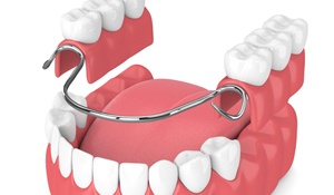 Image of a partial denture