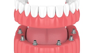 Model of an implant denture