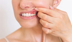 Closeup of patient with red, inflamed gums