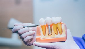 a person holding a model of a dental implant