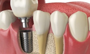 an illustration of a dental implant in the jawbone