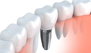 an illustration of a single dental implant