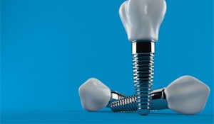 three examples of dental implants and their parts