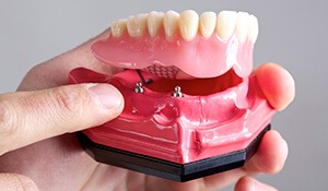 hand pointing to two implant abutments