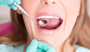 Woman with dental mirror examining open mouth