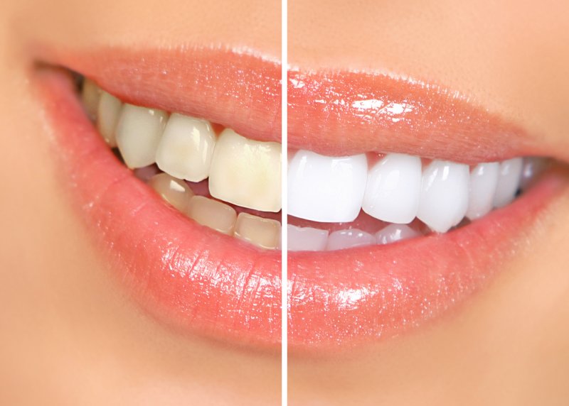 Before-and-after results of teeth whitening