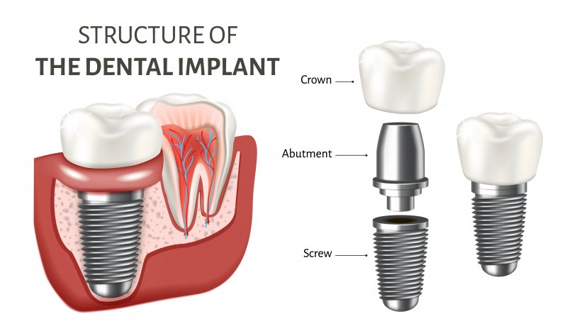 picture of the structure of a dental implant