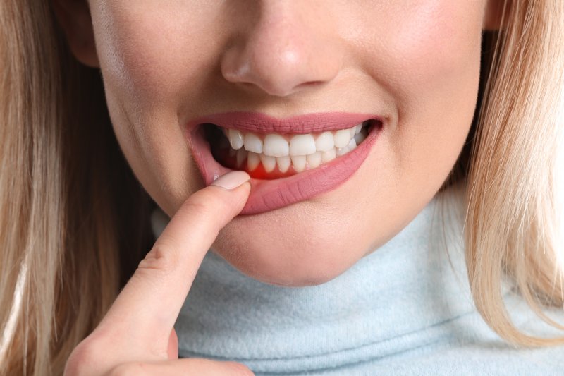 A woman revealing her infected and inflamed gums
